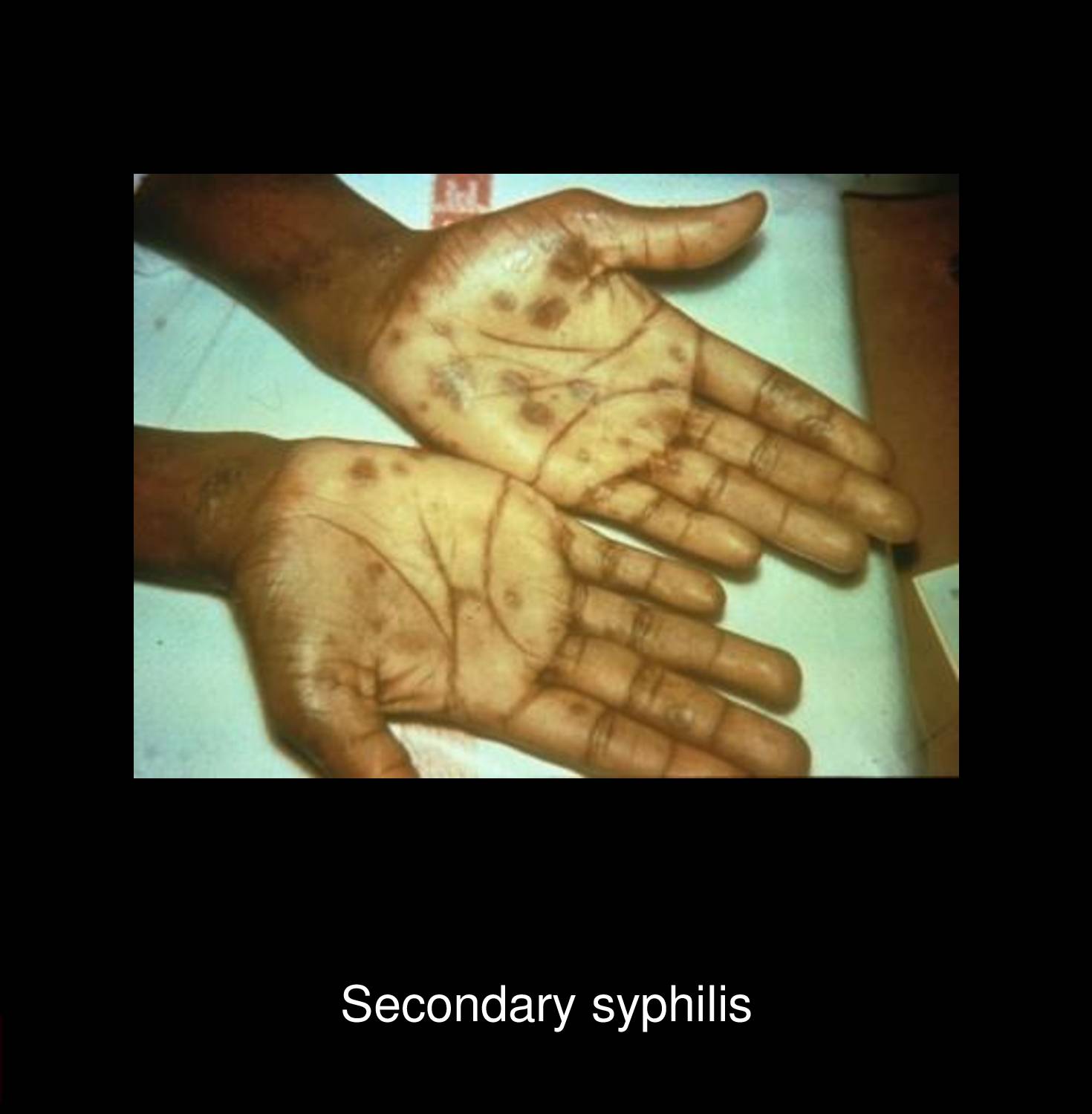 Primary syphilis chancre on female labia showing painless indurated ulcer with clean base characteristic of early Treponema pallidum infection